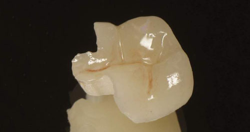 Inlays et Onlays céramiques